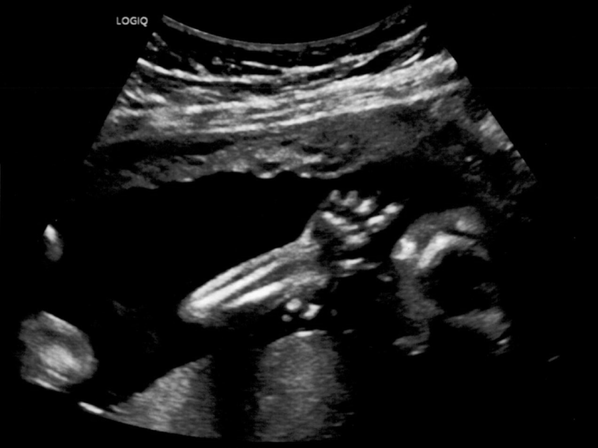 Ultrasound of the baby's open left hand