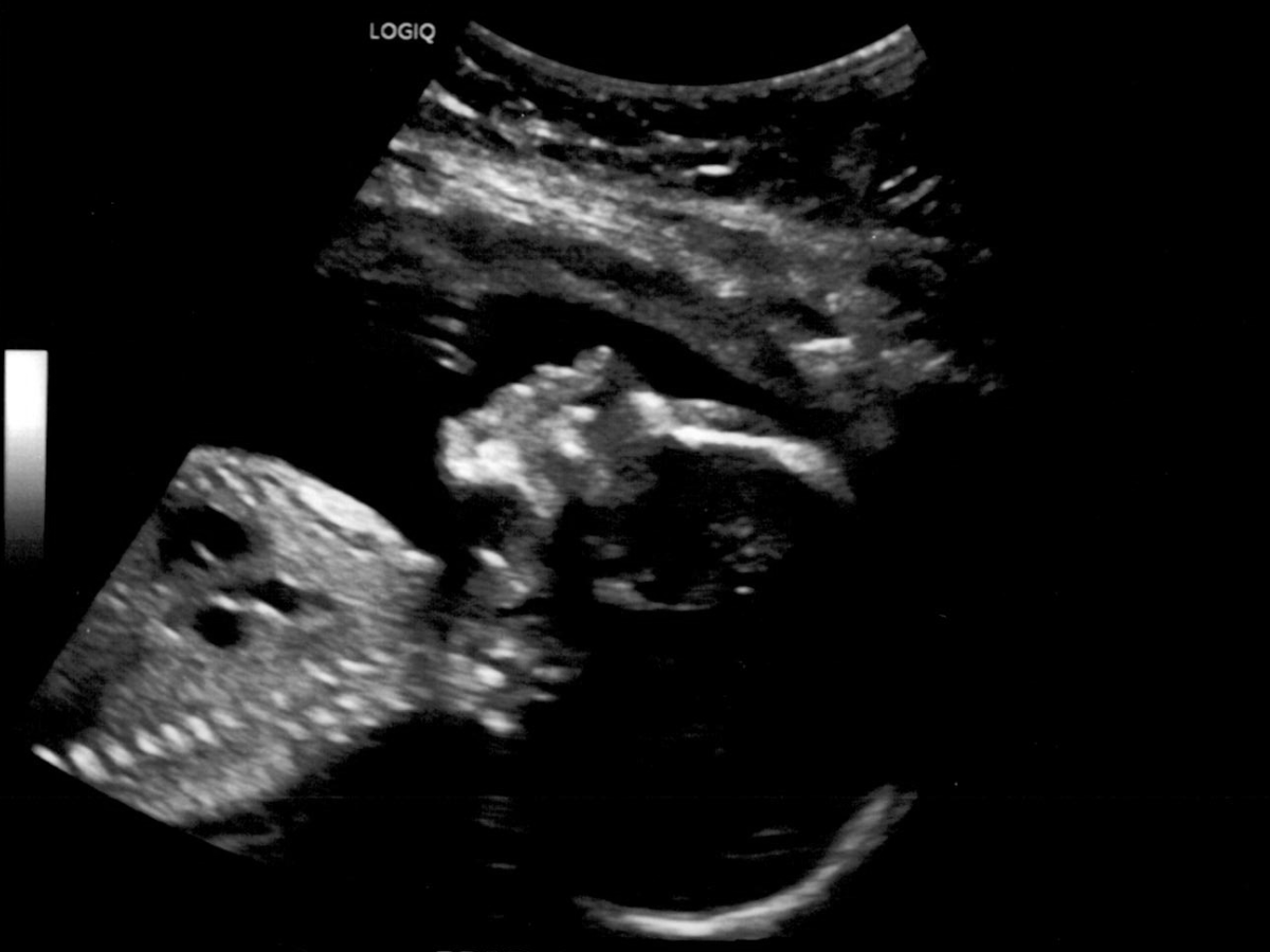 Ultrasound profile view of the baby's face