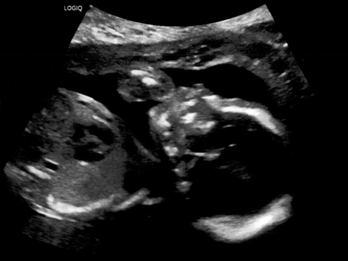 Ultrasound of the baby sucking their thumb